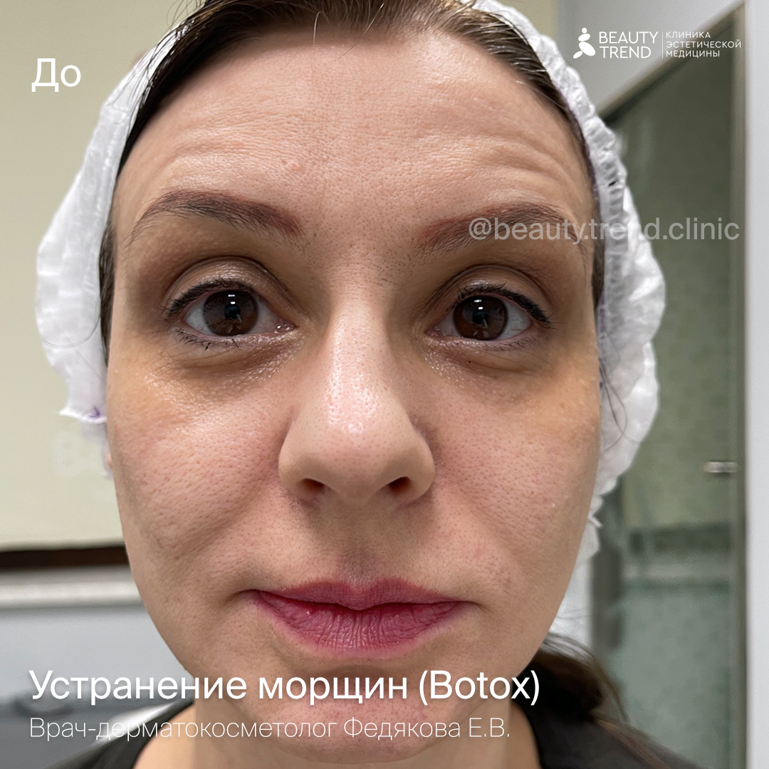 Устранение морщин Botox, Федякова - до 1